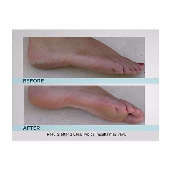 Emjoi Micro Pedi White Callus Remover with Extra Coarse Roller & Cleaning Brush - Picture 8 of 9